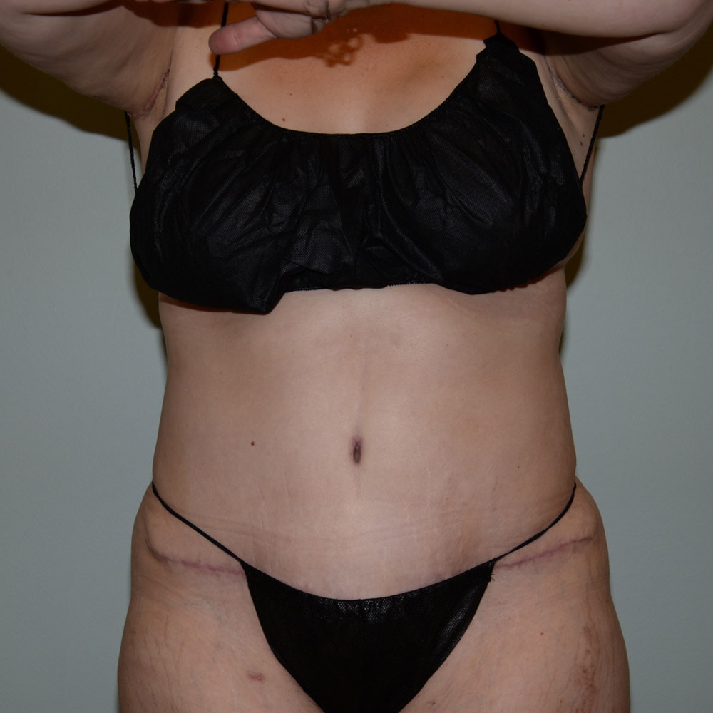 Case 5738 Front View, after Tummy Tuck in Lake Oswego & Portland, OR