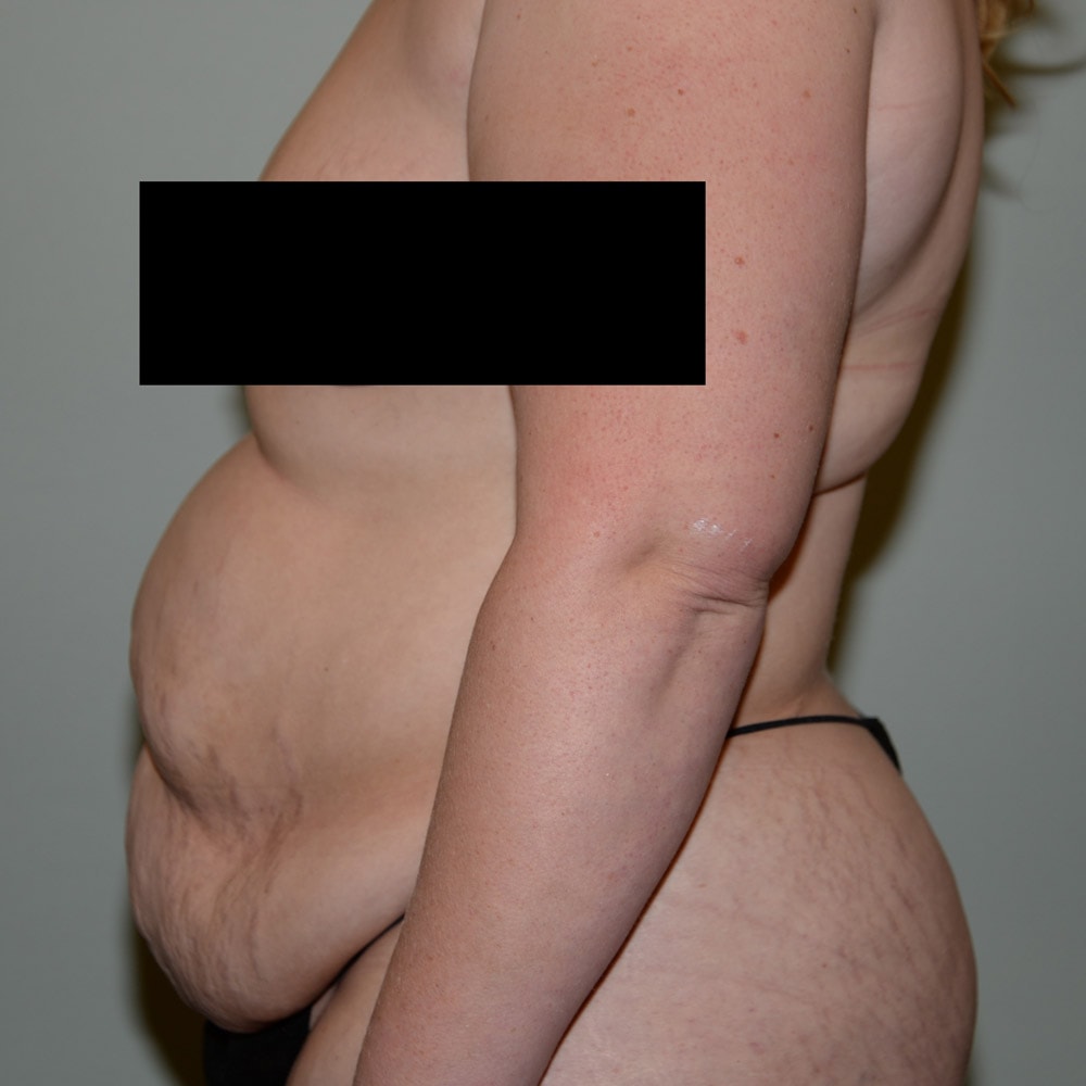 Case 5738 Left View, Before Tummy Tuck in Lake Oswego & Portland, OR