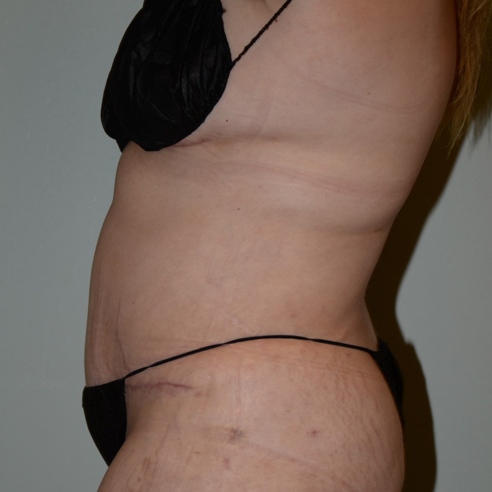 Case--5738 | After Tummy Tuck 2