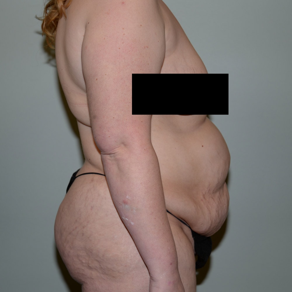 Case 5738 Right View, Before Tummy Tuck in Lake Oswego & Portland, OR