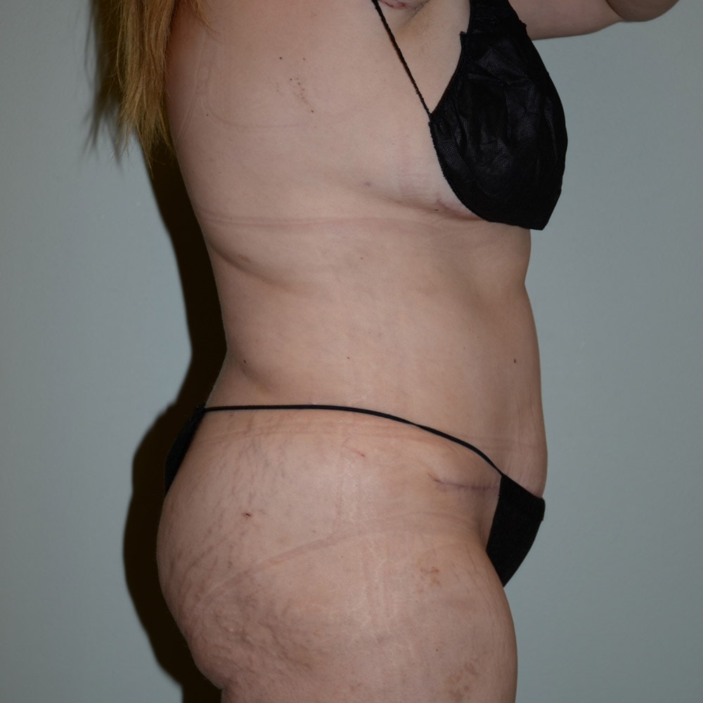 Case 5738 Right View, After Tummy Tuck in Lake Oswego & Portland, OR