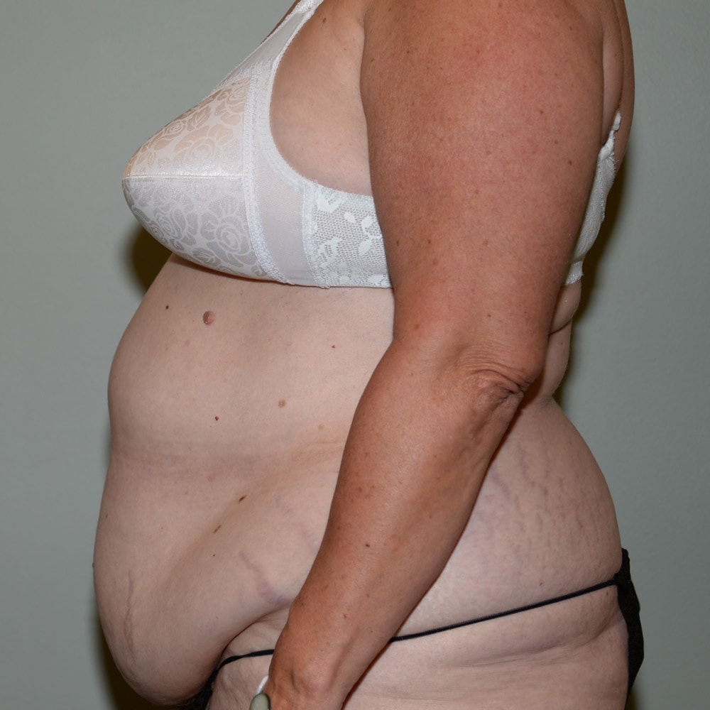 Case 5798 Left View, Before Tummy Tuck in Lake Oswego & Portland, OR