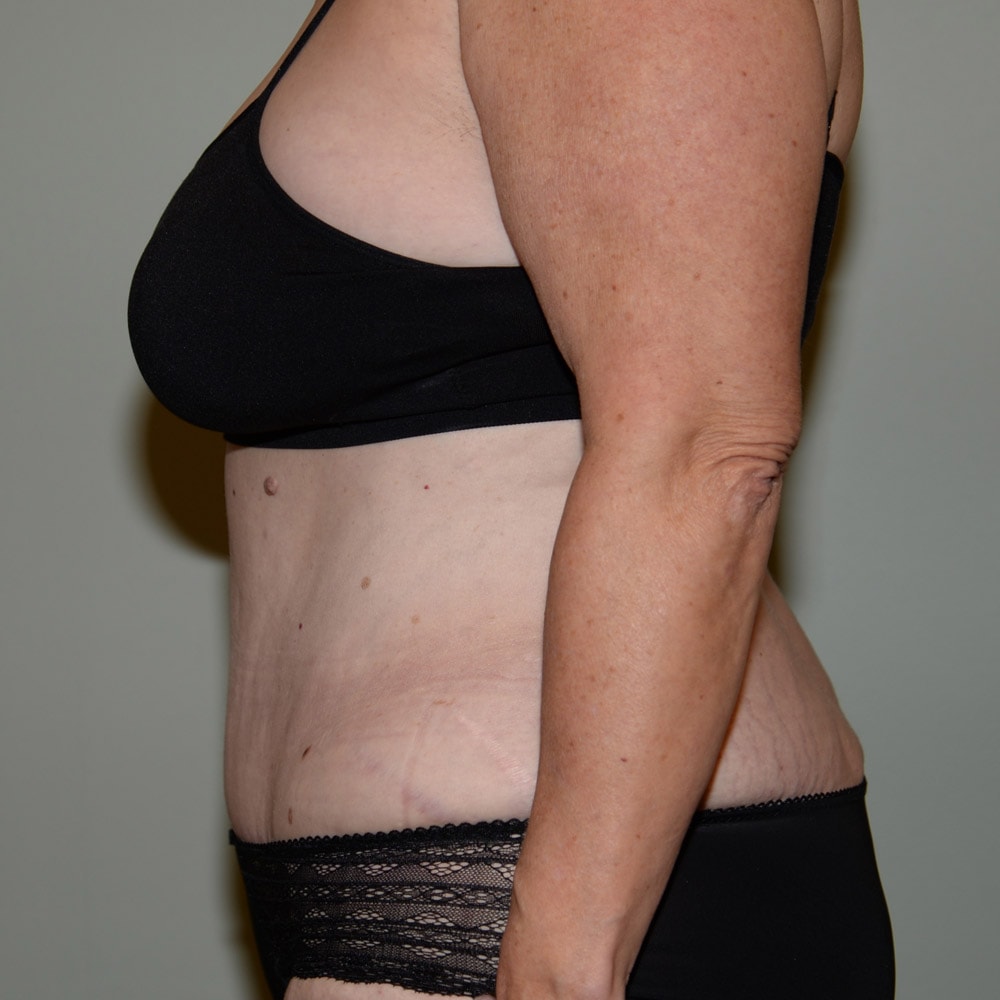 Case 5798 Left View, After Tummy Tuck in Lake Oswego & Portland, OR