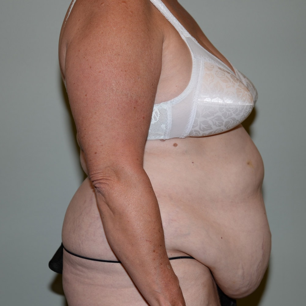 Case 5798 Right View, Before Tummy Tuck in Lake Oswego & Portland, OR
