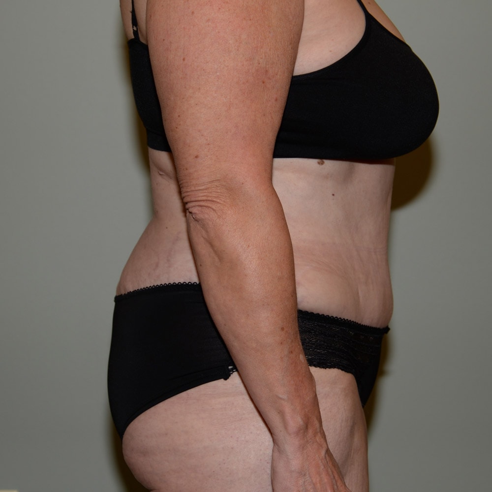 Case--5798 | After Tummy Tuck 3