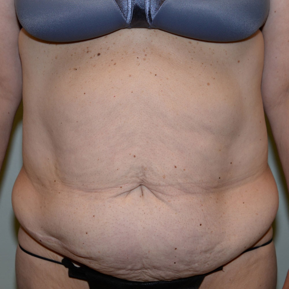 Case 5926 Front View, Before Tummy Tuck in Lake Oswego & Portland, OR