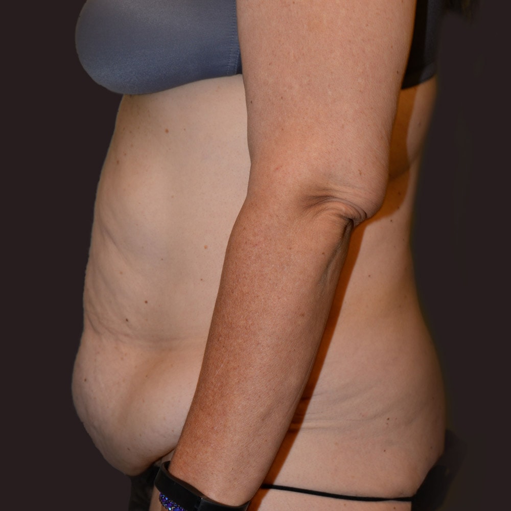Case 5926 Left View, Before Tummy Tuck in Lake Oswego & Portland, OR