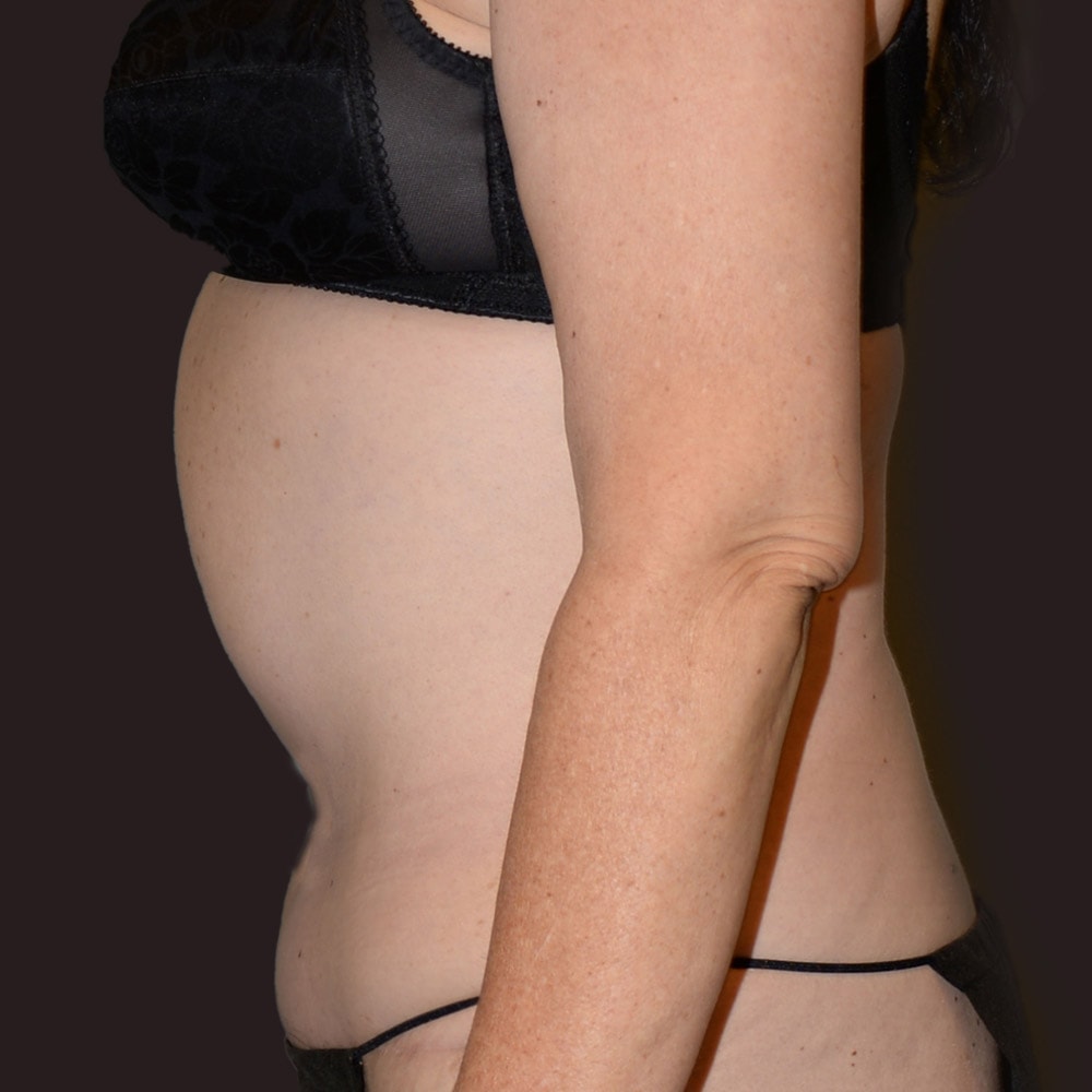 Case 5926 Left View, After Tummy Tuck in Lake Oswego & Portland, OR
