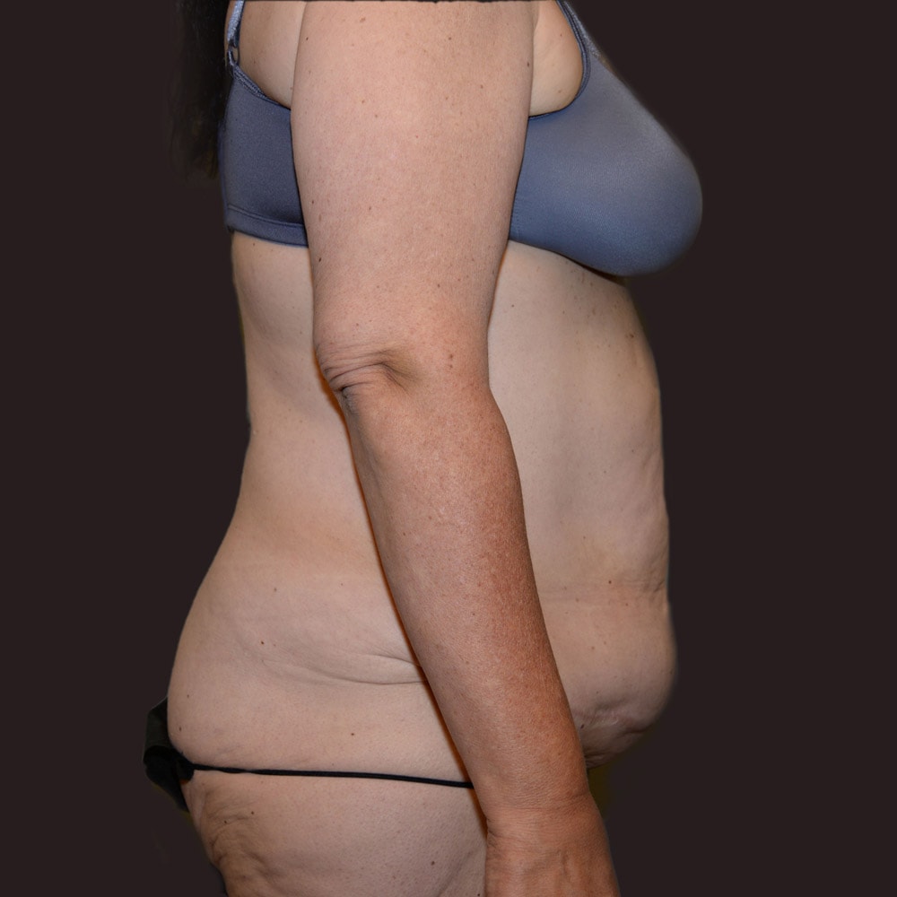 Case 5926 Right View, Before Tummy Tuck in Lake Oswego & Portland, OR