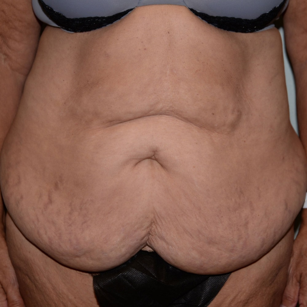 Case 5951 Front View, Before Tummy Tuck in Lake Oswego & Portland, OR