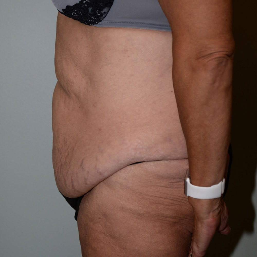 Case 5951 Left View, Before Tummy Tuck in Lake Oswego & Portland, OR