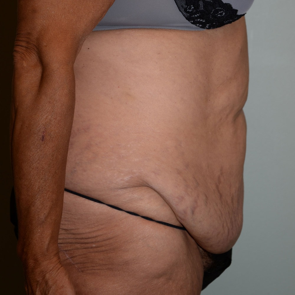 Case 5951 Right View, Before Tummy Tuck in Lake Oswego & Portland, OR