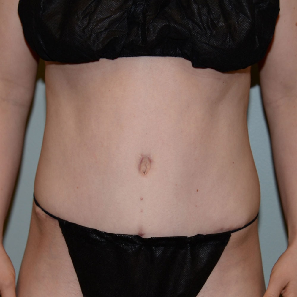 Case 6377 Front View, After Tummy Tuck in Lake Oswego & Portland, OR