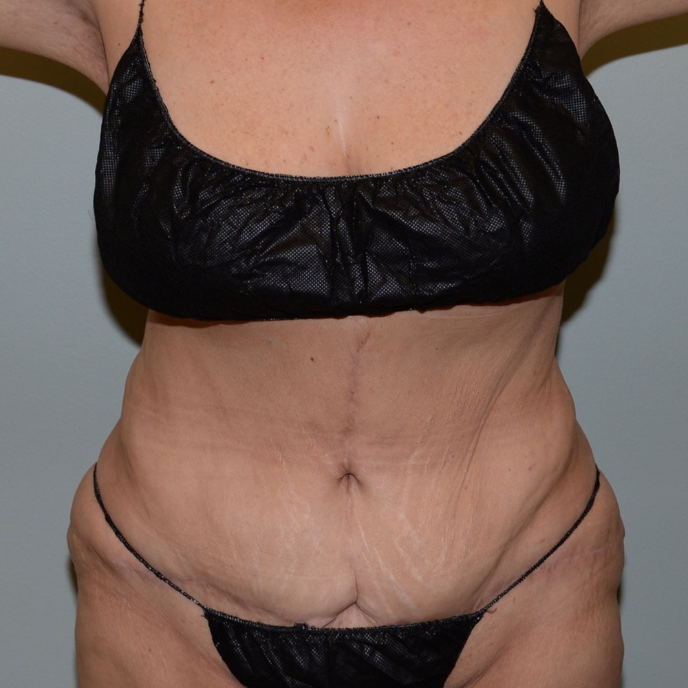 Case 6667 Front View, After Tummy Tuck in Lake Oswego & Portland, OR