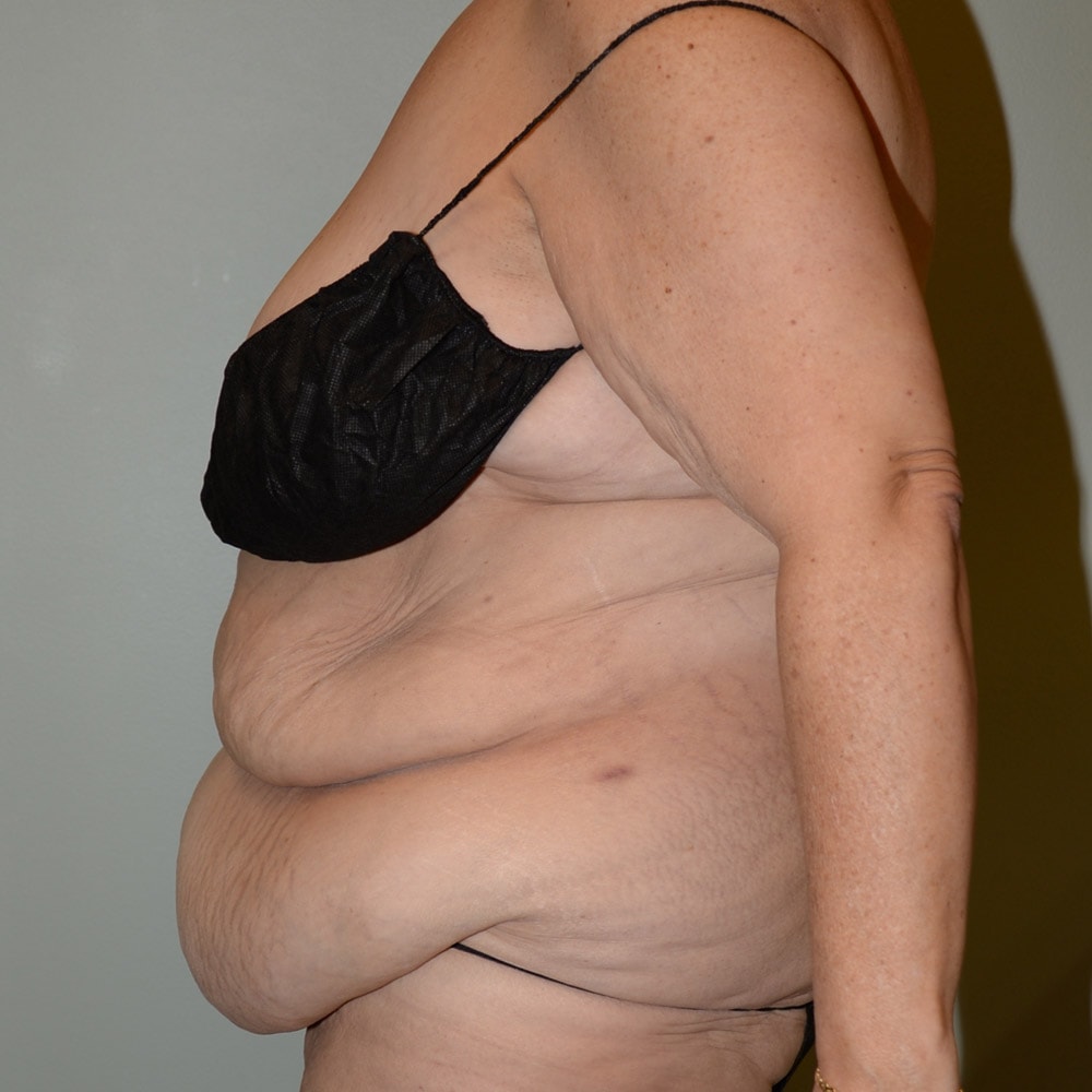 Case 6667 Left View, Before Tummy Tuck in Lake Oswego & Portland, OR