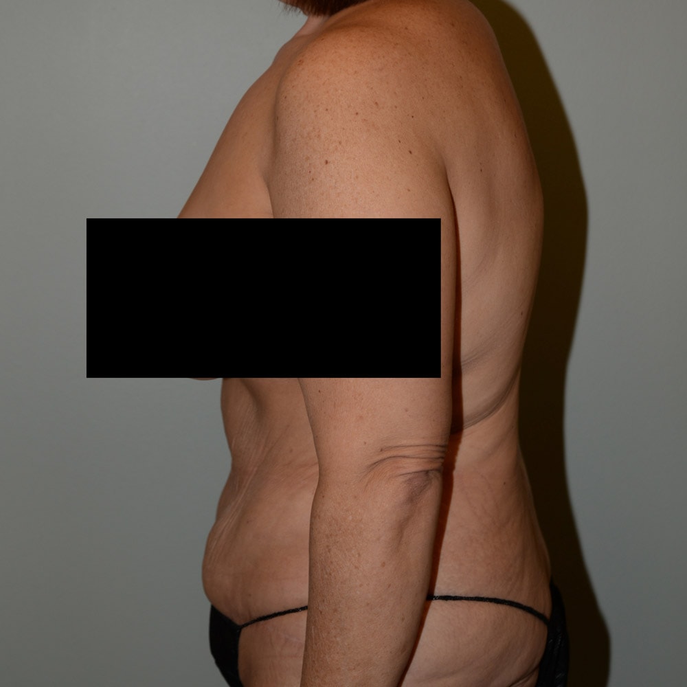 Case 6667 Left View, After Tummy Tuck in Lake Oswego & Portland, OR