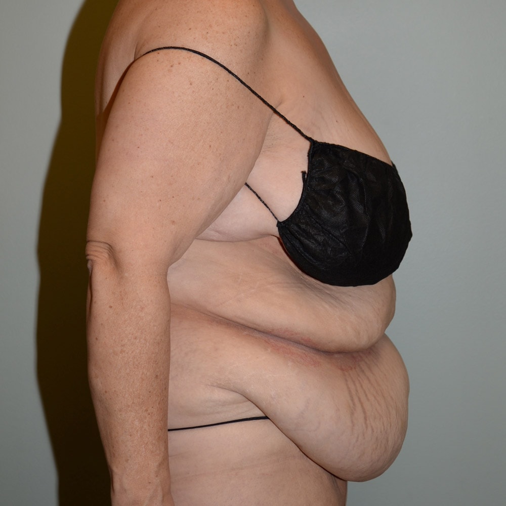 Case 6667 Right View, Before Tummy Tuck in Lake Oswego & Portland, OR