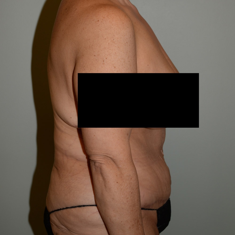 Case 6667 Right View, After Tummy Tuck in Lake Oswego & Portland, OR