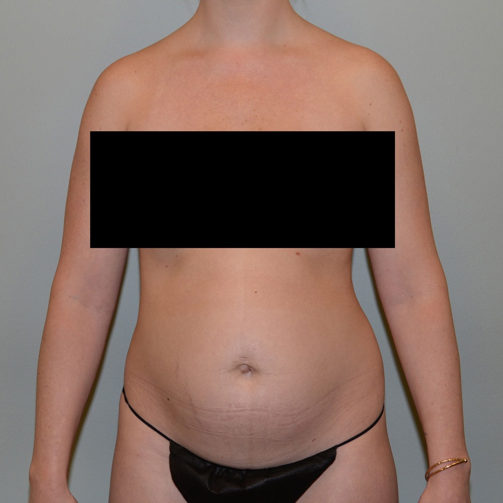Case 7496 Front View, Before Tummy Tuck in Lake Oswego & Portland, OR