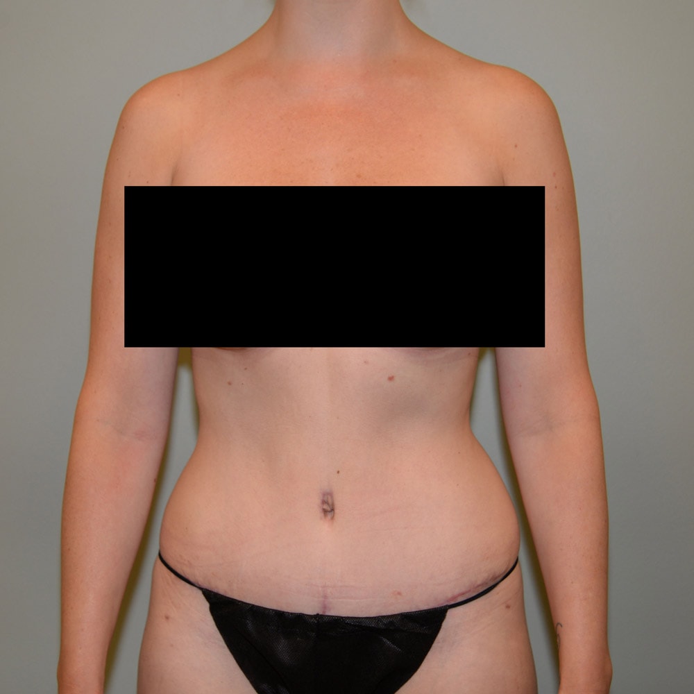 Case 7496 Front View, After Tummy Tuck in Lake Oswego & Portland, OR