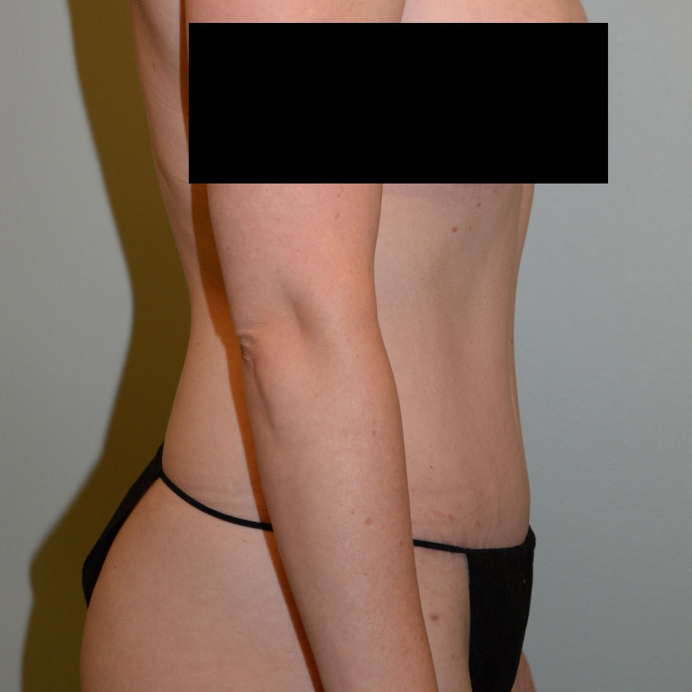 Case 7496 Right View, After Tummy Tuck in Lake Oswego & Portland, OR