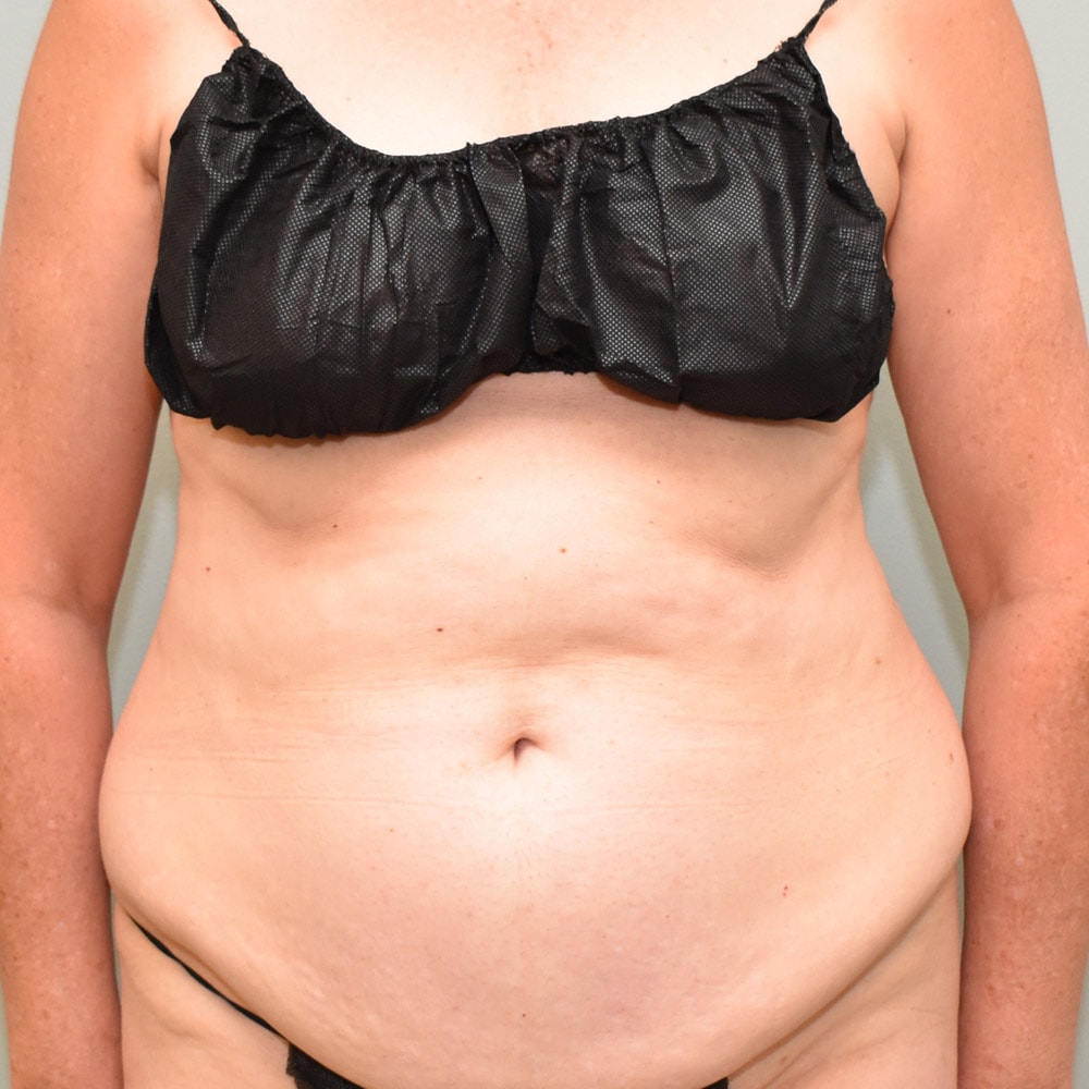 Case 7588 Front View, Before Tummy Tuck in Lake Oswego & Portland, OR