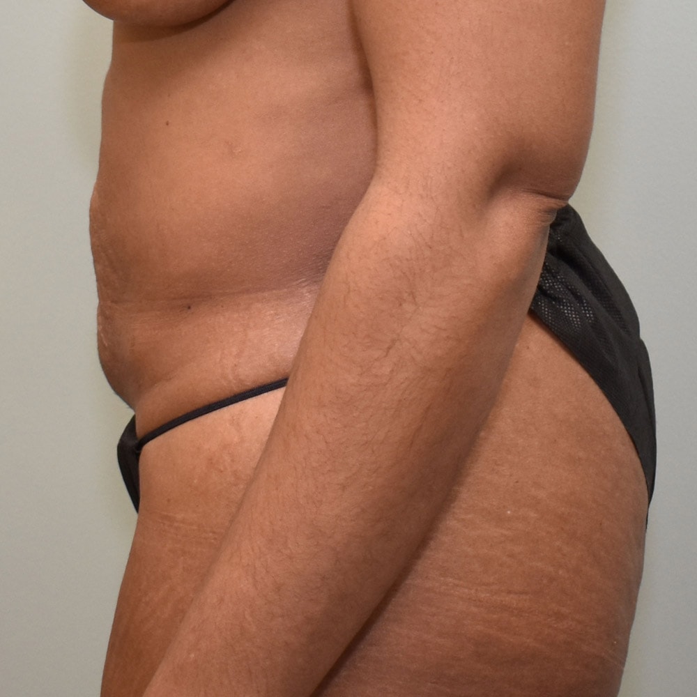 Case 7845 Left View, Before Tummy Tuck in Lake Oswego & Portland, OR