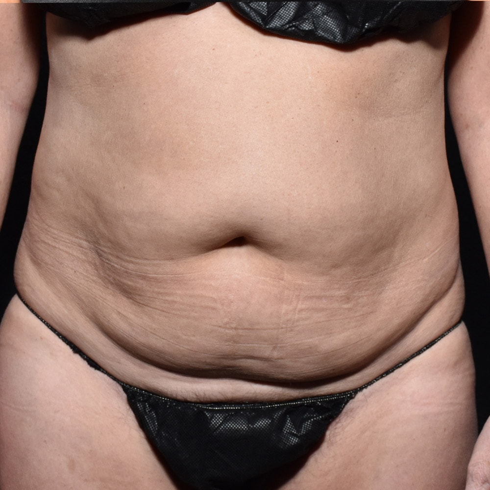 Case 9360 Front View, Before Tummy Tuck in Lake Oswego & Portland, OR