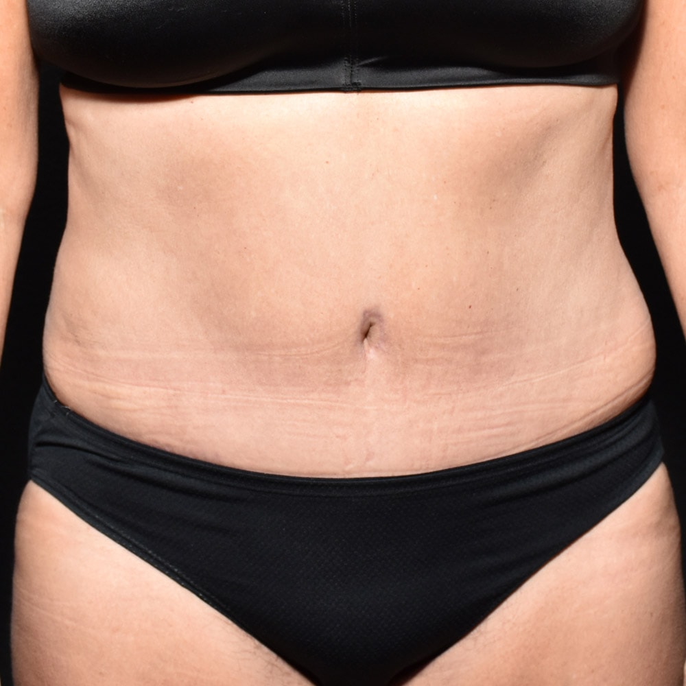 Case 9360 Front View, After Tummy Tuck in Lake Oswego & Portland, OR