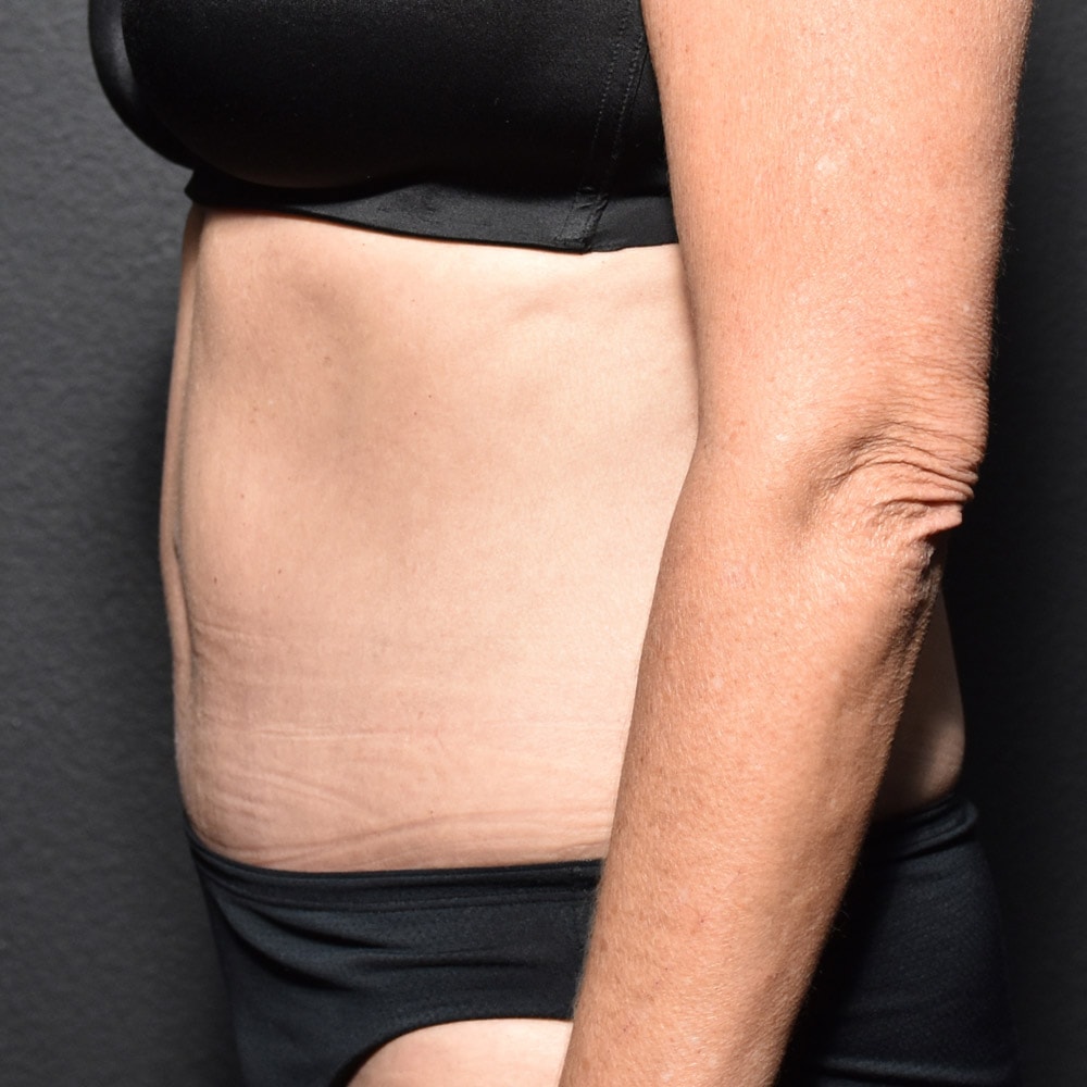 Case 9360 Left View, After Tummy Tuck in Lake Oswego & Portland, OR