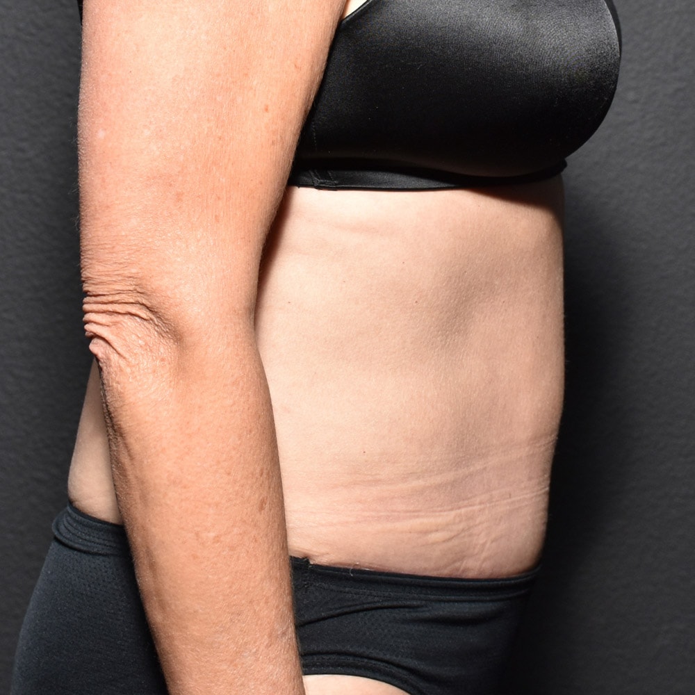 Case 9360 Right View, After Tummy Tuck in Lake Oswego & Portland, OR