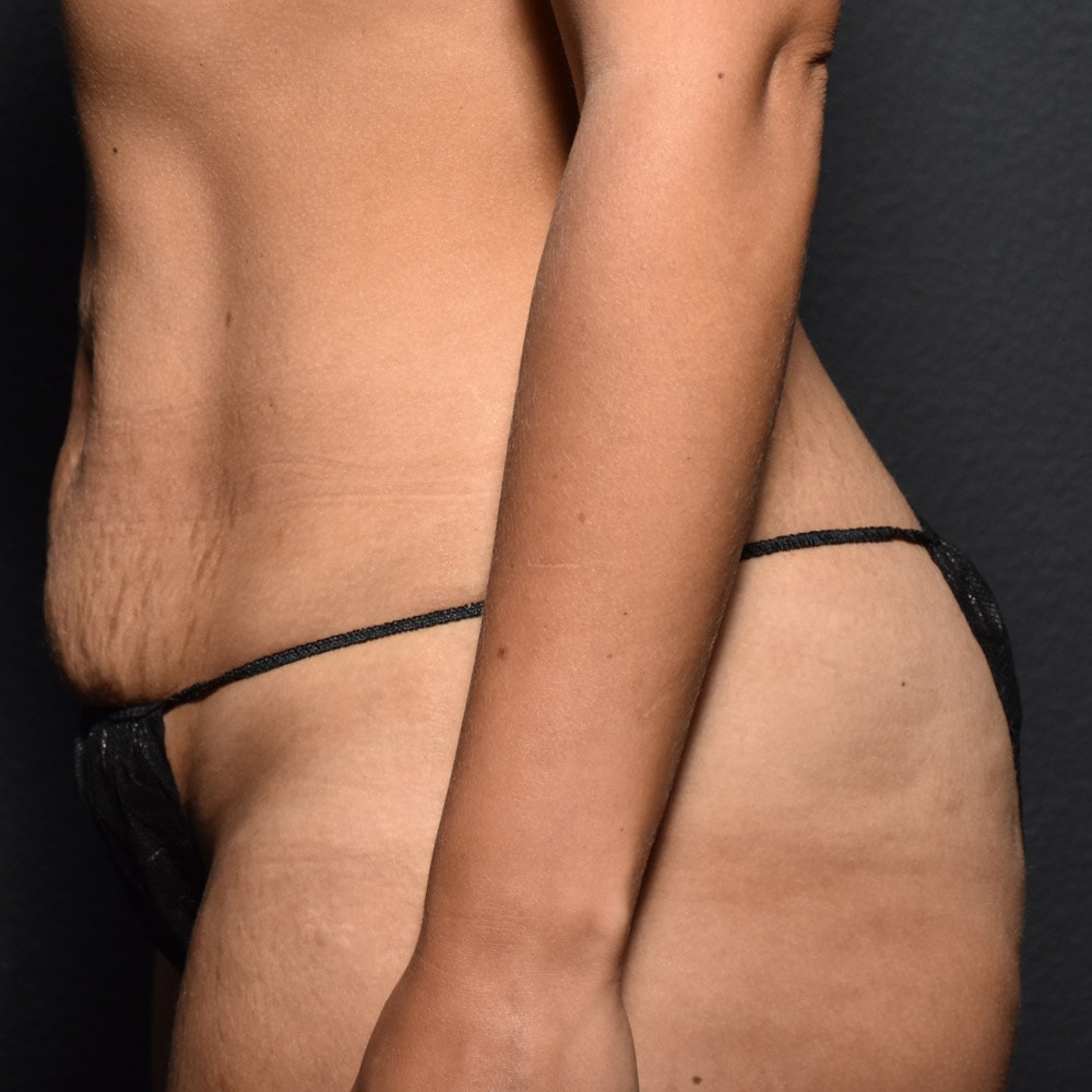 Case 9401 Left View, Before Tummy Tuck in Lake Oswego & Portland, OR