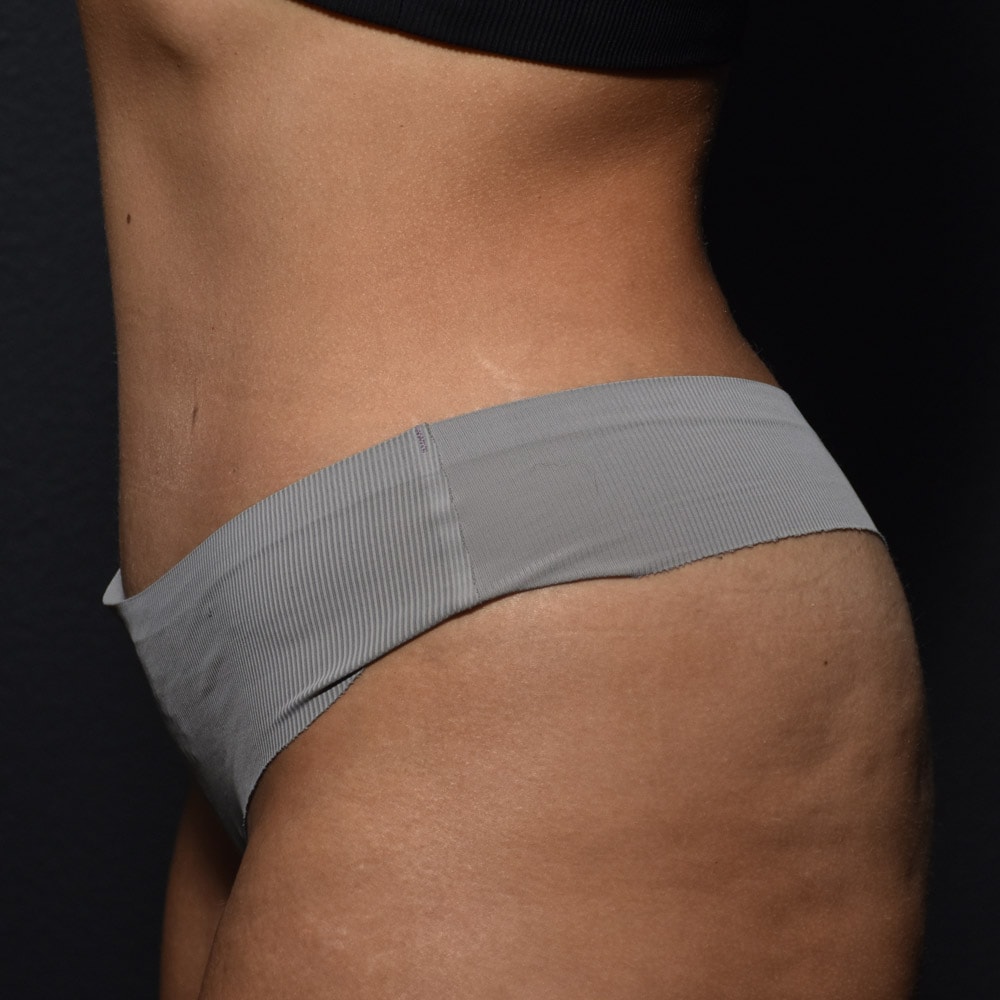 Case 9401 Left View, After Tummy Tuck in Lake Oswego & Portland, OR