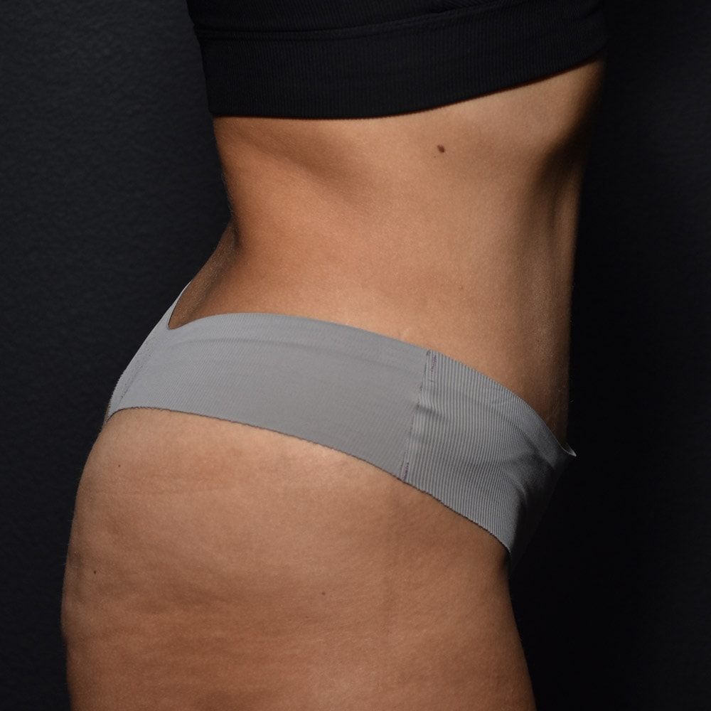 Case 9401 Right View, After Tummy Tuck in Lake Oswego & Portland, OR