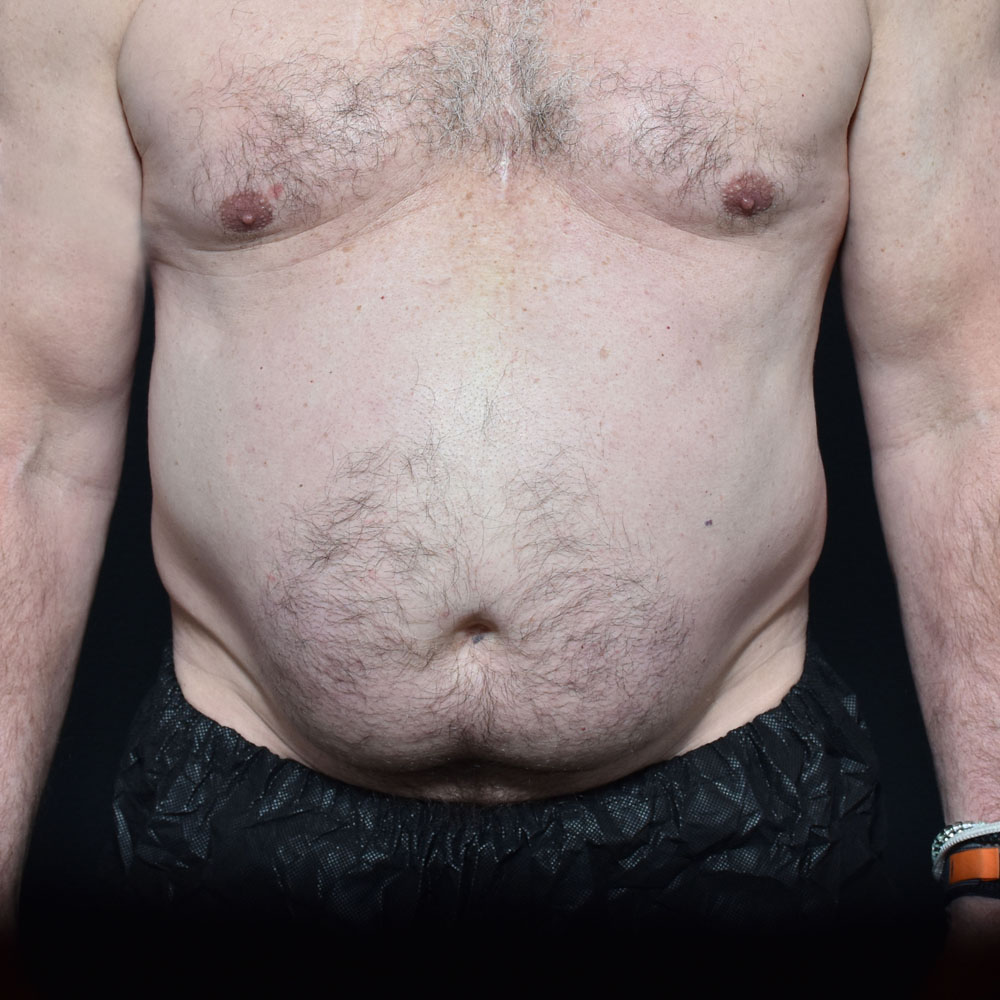 Case 11467 Front View, Before Male Tummy Tuck in Lake Oswego & Portland, OR