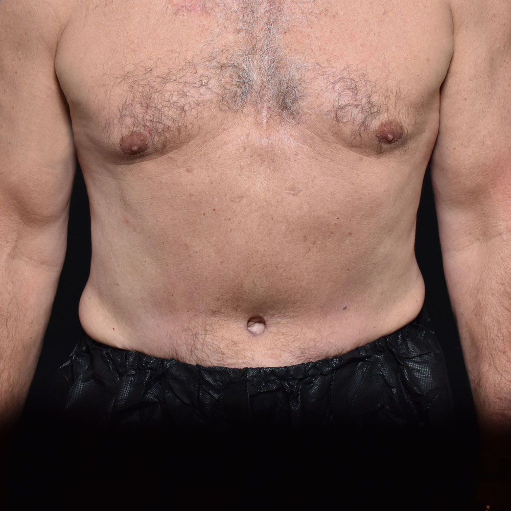 Case 11467 Front View, After Male Tummy Tuck in Lake Oswego & Portland, OR