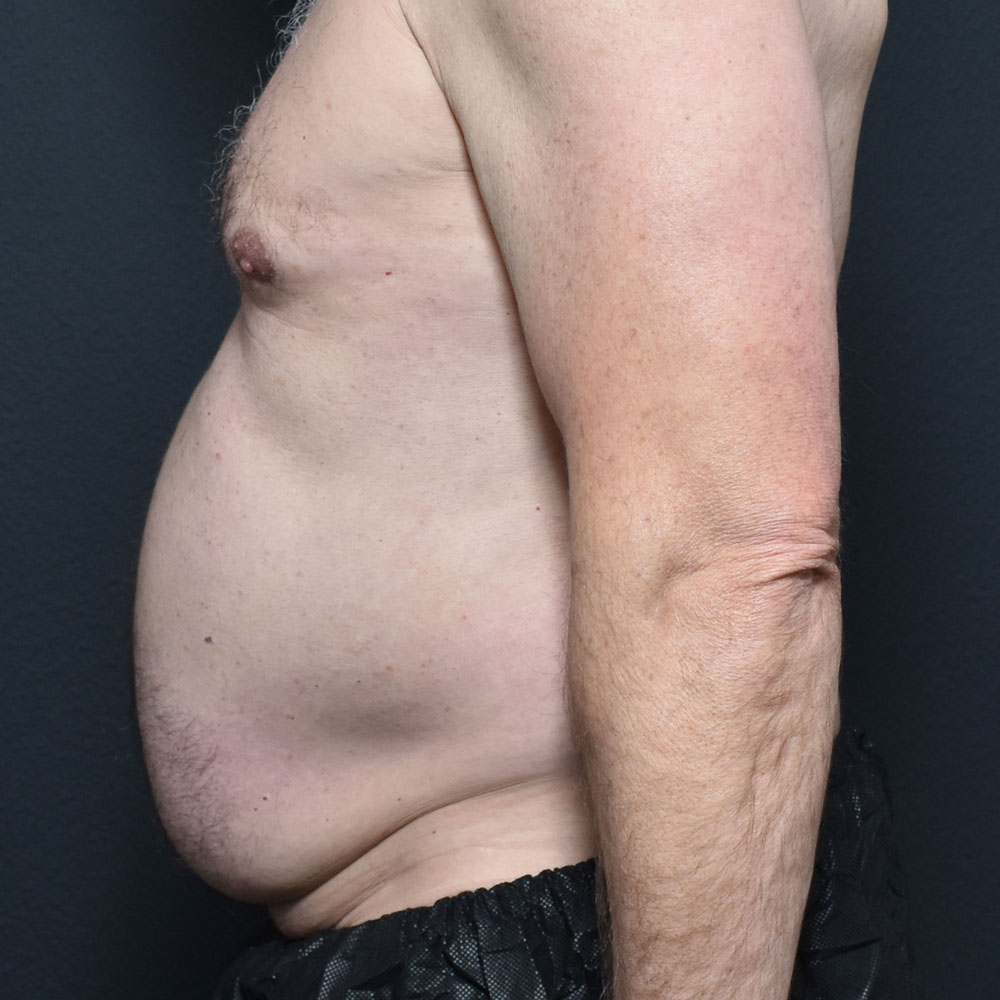 Case 11467 Side View, Before Male Tummy Tuck in Lake Oswego & Portland, OR