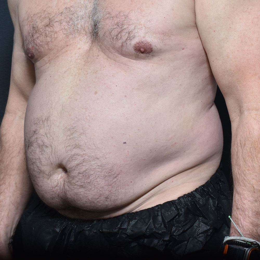 Case 11467 Oblique View, Before Male Tummy Tuck in Lake Oswego & Portland, OR