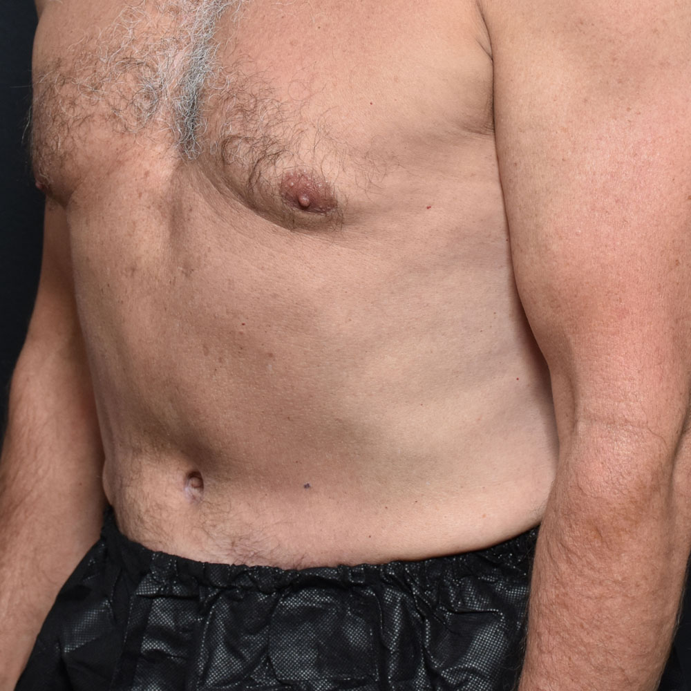 Case 11467 Oblique View, After Male Tummy Tuck in Lake Oswego & Portland, OR