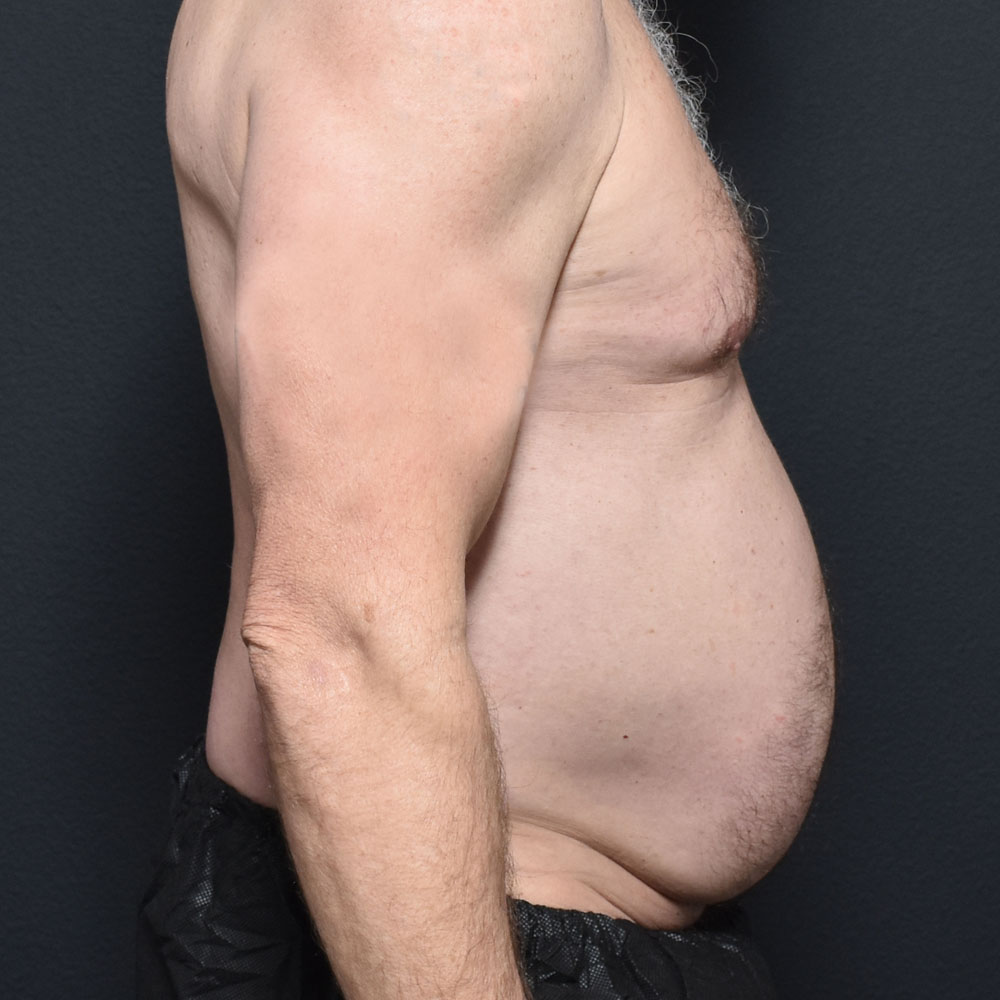 Case 11467 Side View, Before Male Tummy Tuck in Lake Oswego & Portland, OR