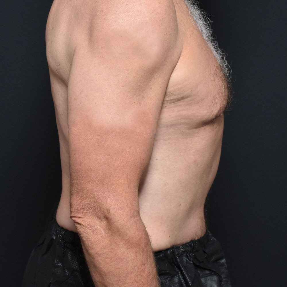 Case 11467 Side View, After Male Tummy Tuck in Lake Oswego & Portland, OR