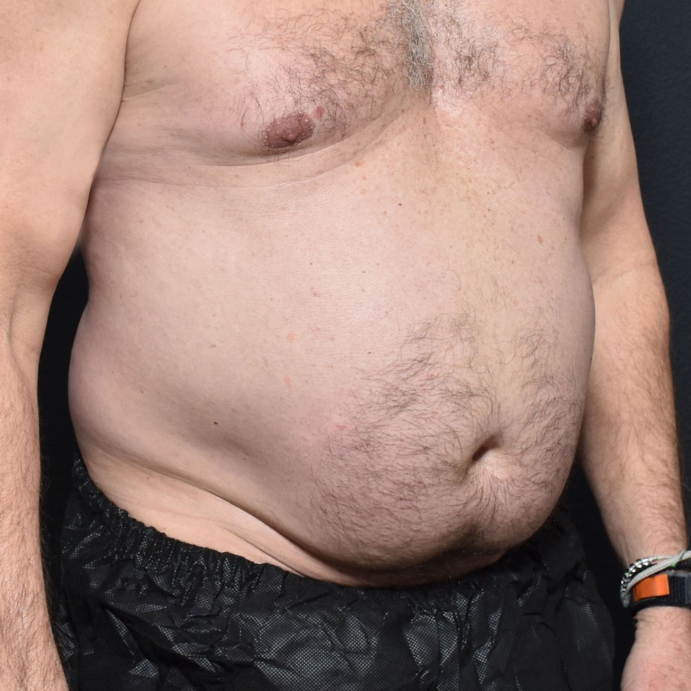 Case 11467 Oblique View, Before Male Tummy Tuck in Lake Oswego & Portland, OR