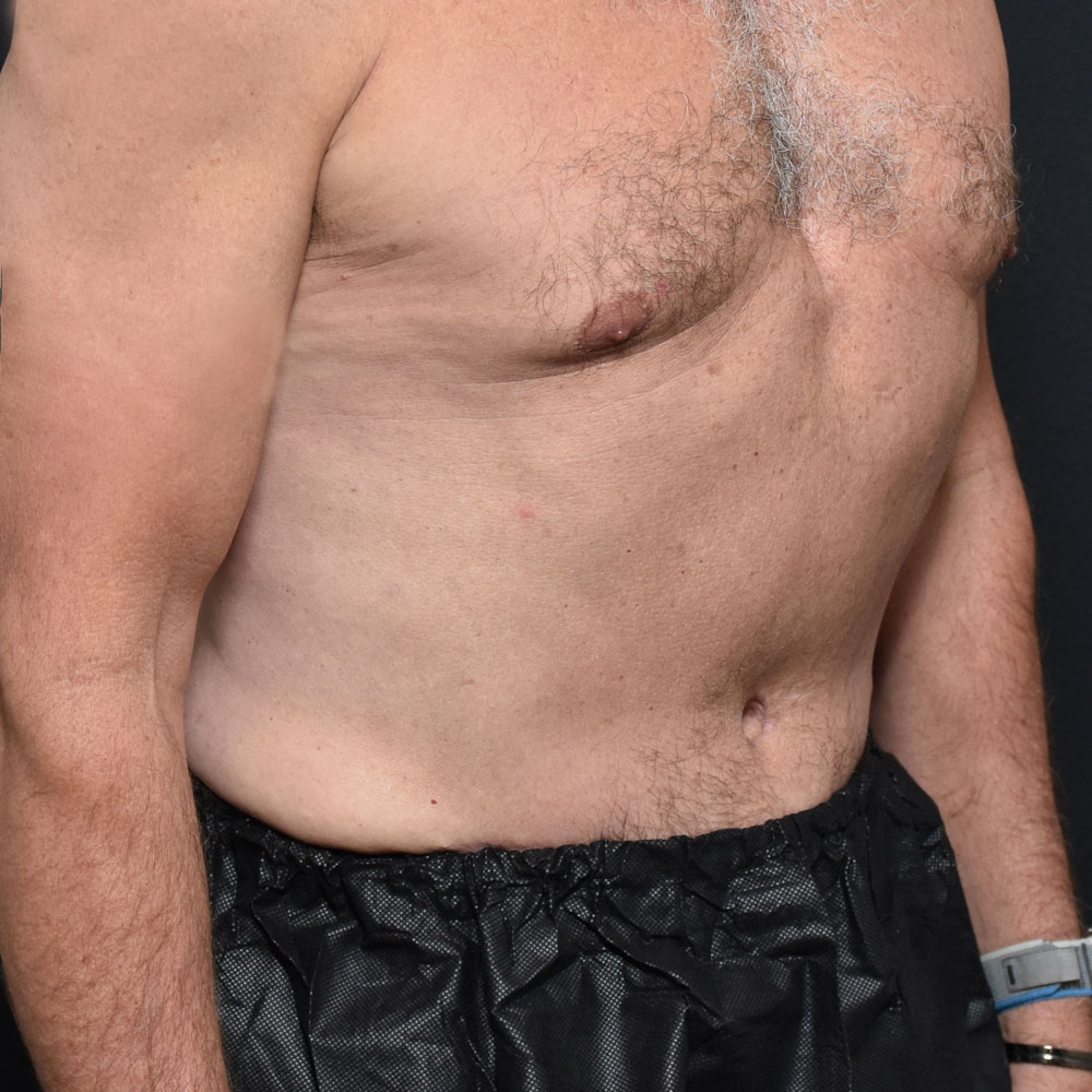 Case 11467 Oblique View, After Male Tummy Tuck in Lake Oswego & Portland, OR