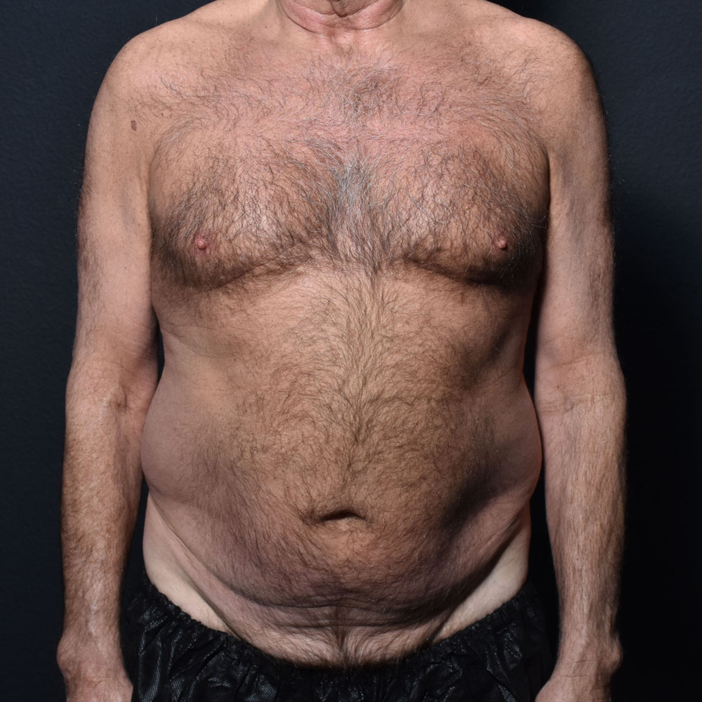 Case 9863 Front View, Before Male Tummy Tuck in Lake Oswego & Portland, OR