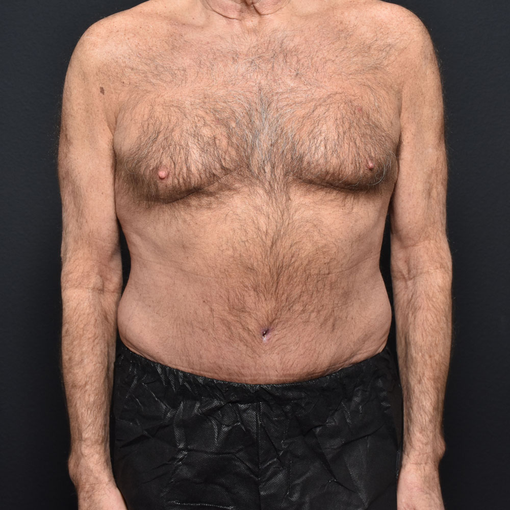 Case 9863 Front View, After Male Tummy Tuck in Lake Oswego & Portland, OR