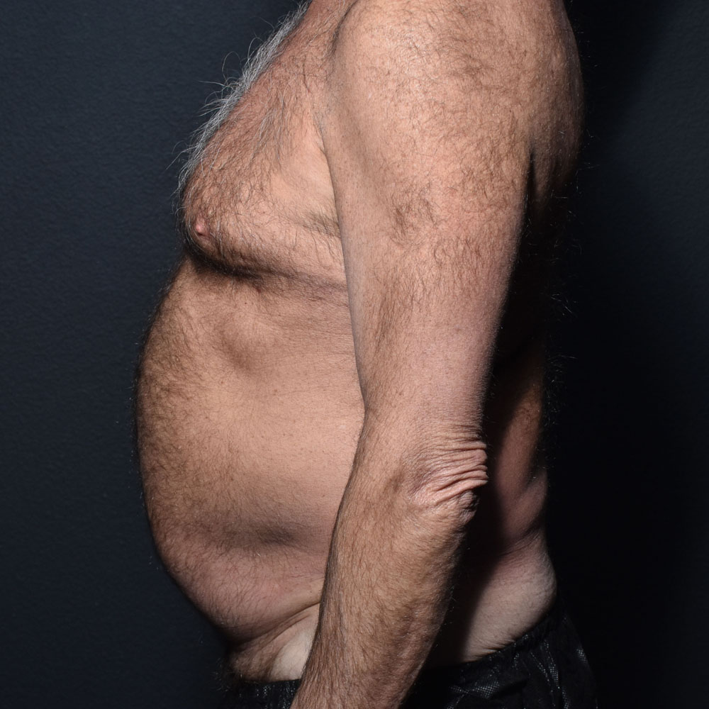 Case 9863 Side View, Before Male Tummy Tuck in Lake Oswego & Portland, OR