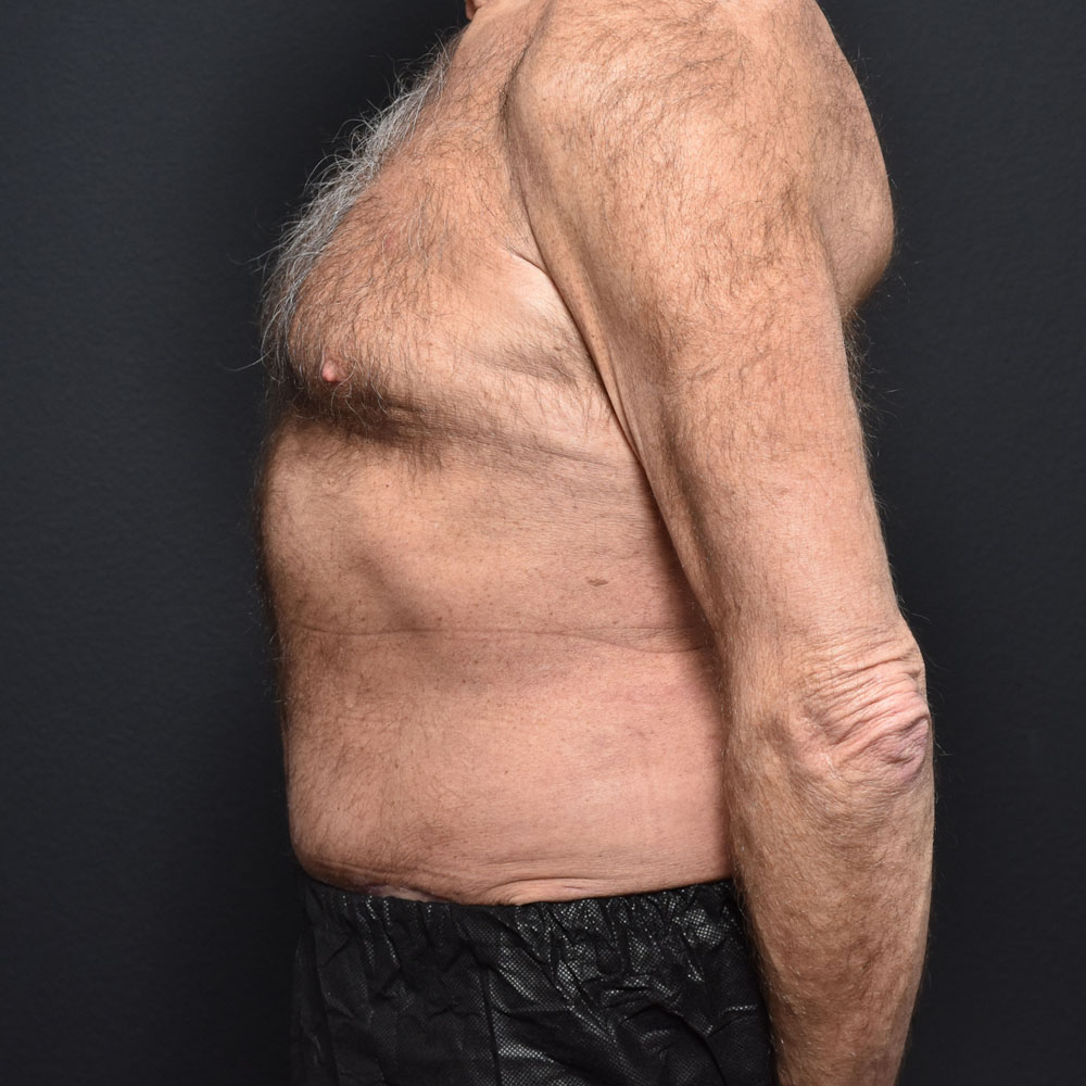 Case 9863 Side View, After Male Tummy Tuck in Lake Oswego & Portland, OR