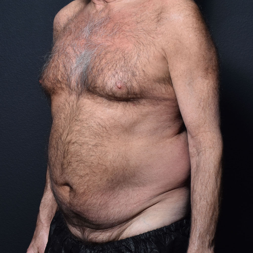 Case 9863 Oblique View, Before Male Tummy Tuck in Lake Oswego & Portland, OR