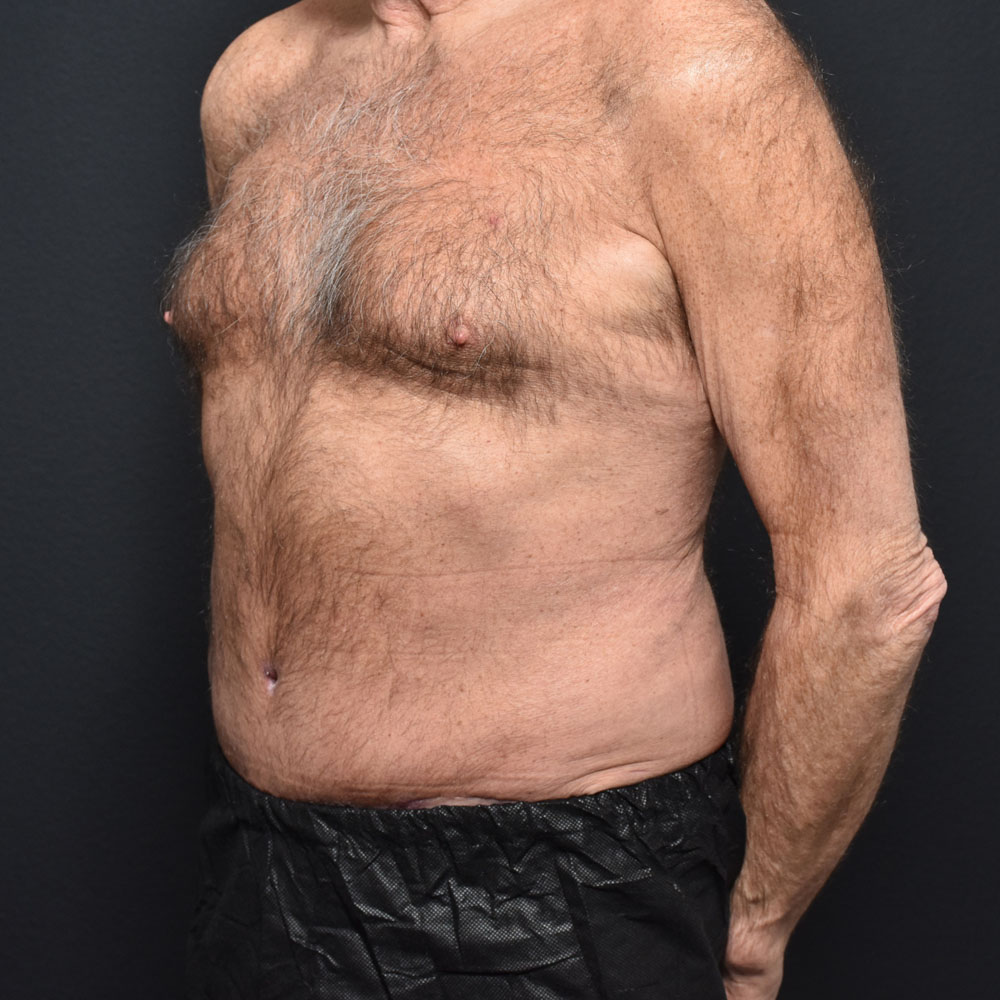 Case 9863 Oblique View, After Male Tummy Tuck in Lake Oswego & Portland, OR