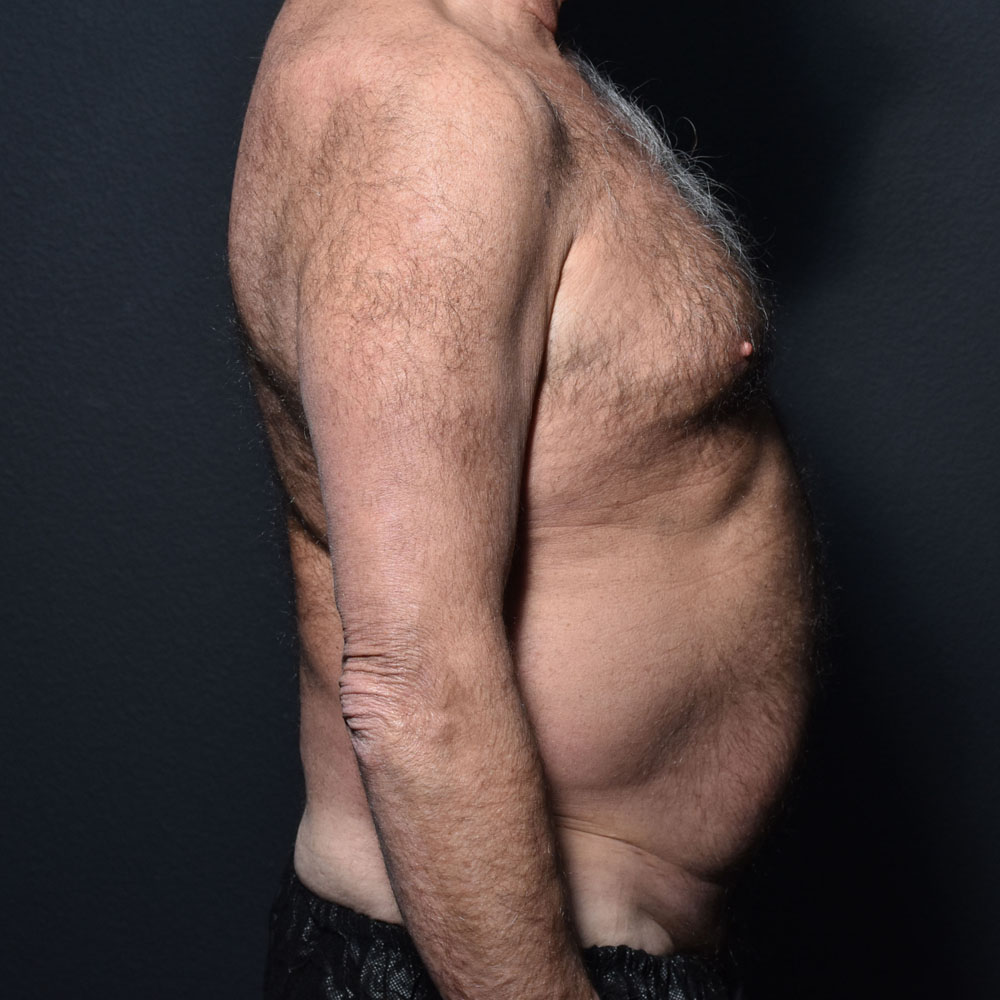 Case 9863 Side View, Before Male Tummy Tuck in Lake Oswego & Portland, OR